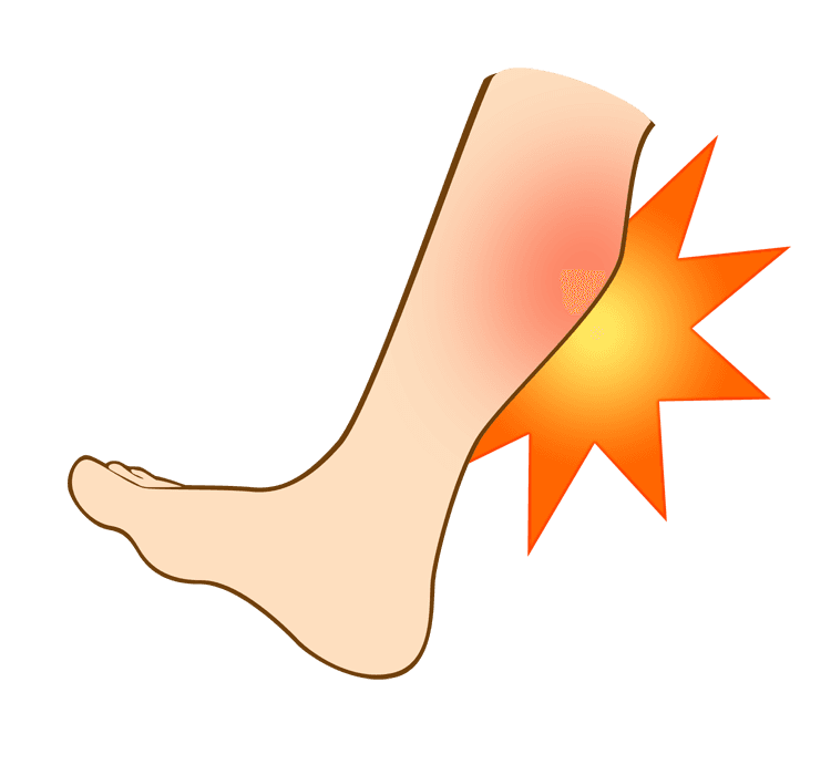 足がつってふくらはぎに痛みが出るのを表したイラスト